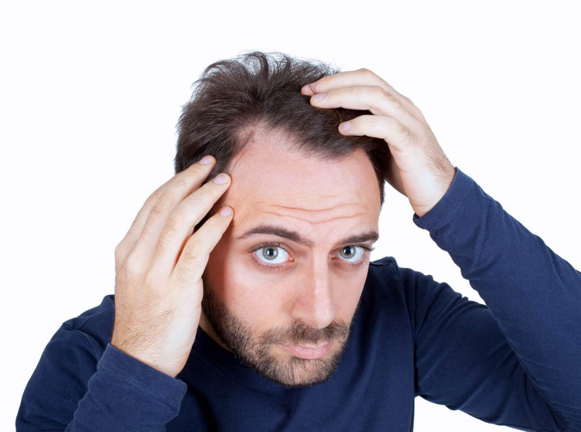 The 5 Hair Loss Treatments For Men