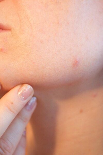 Acne, Pores, Skin, Pimple, Female, Face, Skincare