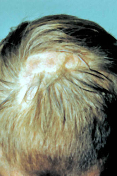 This image shows a patient with ringworm of the scalp, 'tinea capitis', due to an infection caused by Microsporum canis.