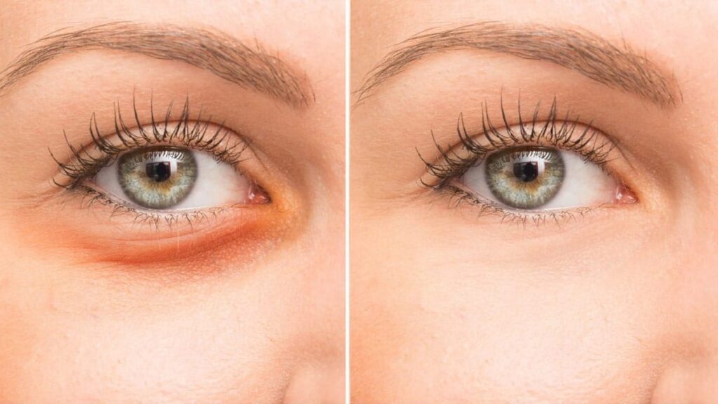 A Comprehensive Guide to Plasma Pens Treatment