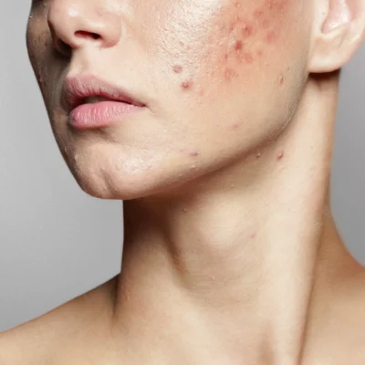 Essential Things You Didn’t Know About Acne